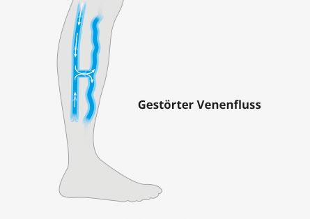 Chronisch venöse Insuffizienz